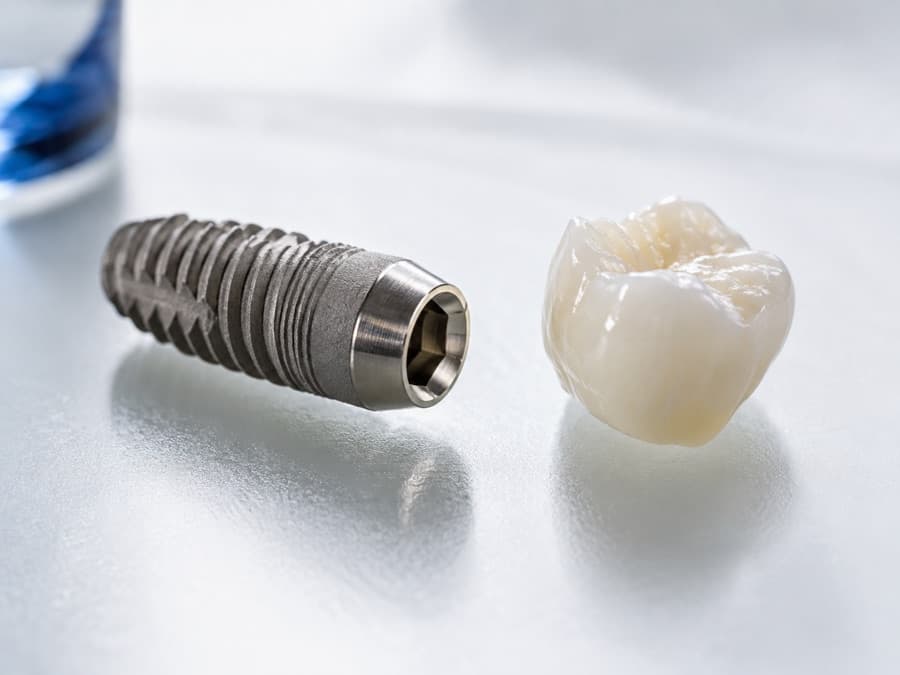 Imagine editorială despre implantologie dentară